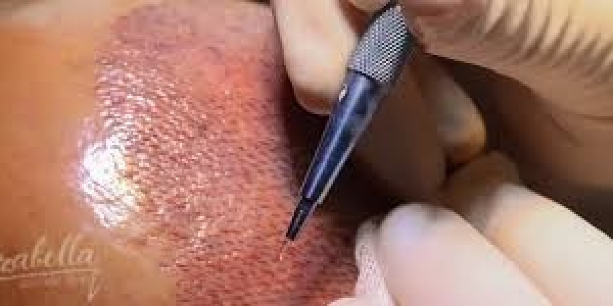 بديل زراعة الشعر في مصر