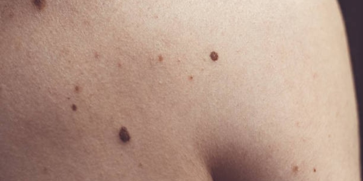 Mole Removal: A Step-by-Step Overview for First-Timers