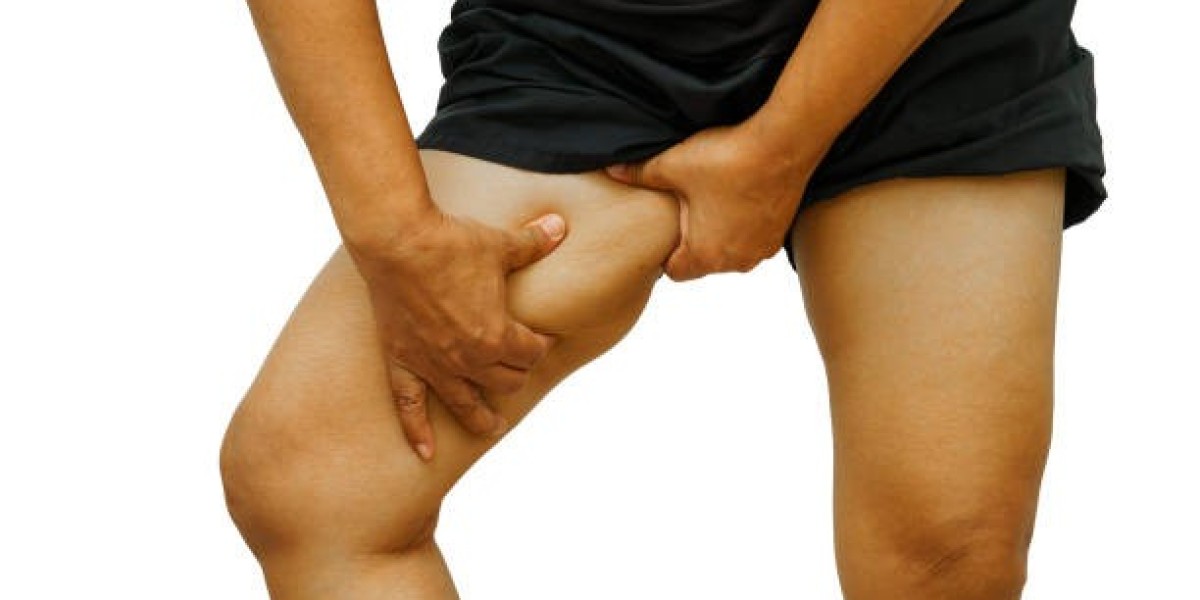 Daily Skin Care Tips for Lipedema-Prone Areas